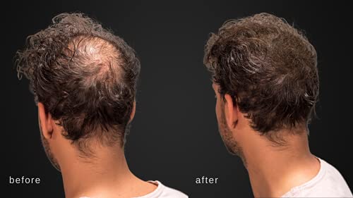 Saç İnceltme/Saç Dökülmesi için gerçek Keratinli MAXX PRO SERİSİ Hacim Veren Saç Lifleri - Dermatolog Tarafından Test Edilmiş