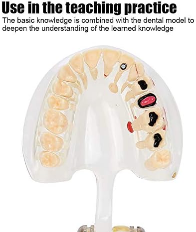 Çıkarılabilir Diş Diş Modeli, Patolojik Diş Modeli Simülasyon Patolojik Onarım Okuyan Öğretim Aracı Diş Hekimi Gösteri için-Sarı
