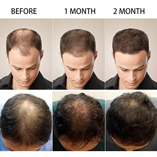 Zencefil Germinal Yağı Zencefil Saç Büyüme Yağı Saç büyüme Serumu Saç Bakım Serumu Durdurma Saç Dökülmesi Sıvı Tedavisi Kadınlar