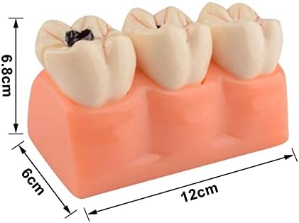 WSXKA Diş Patolojik Çürük Modeli, 4 Kez Diş Diş Çürüğü Modeli Çıkarılabilir, Model Diş Diş Eğitim Malzemeleri için, diş Çürüğü